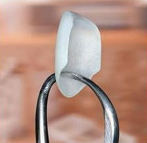 A dental tool holding up a single Lumineer