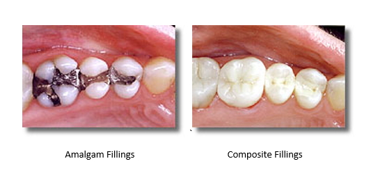 Before and After Composite Fillings