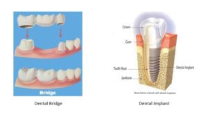 An illustration of a dental bridge versus a dental implant.