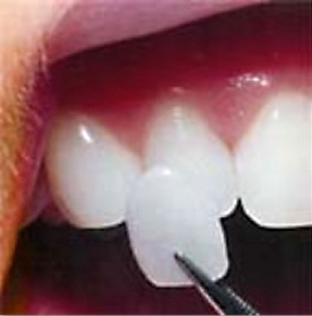 porcelain veneer being held up to a tooth