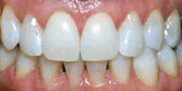 At Home Teeth Whitening, After picture