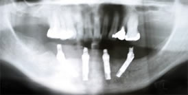 Phoenix All-on-Four Dental Implants